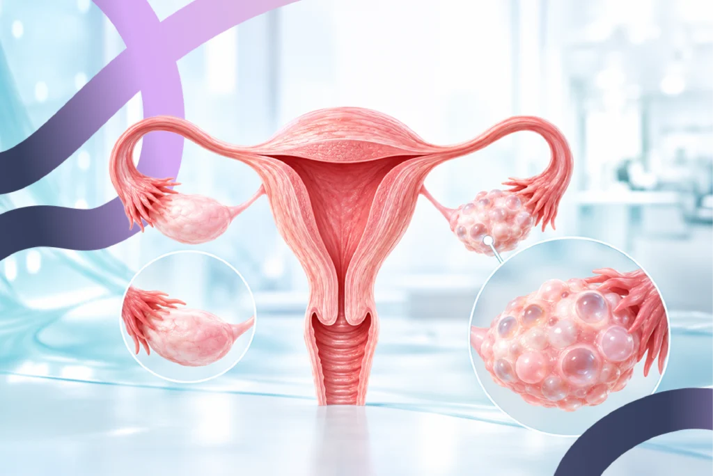 Ovario poliquístico (SOP, ahora SOMP) y fertilidad: cómo afecta y qué se puede hacer para lograr un embarazo